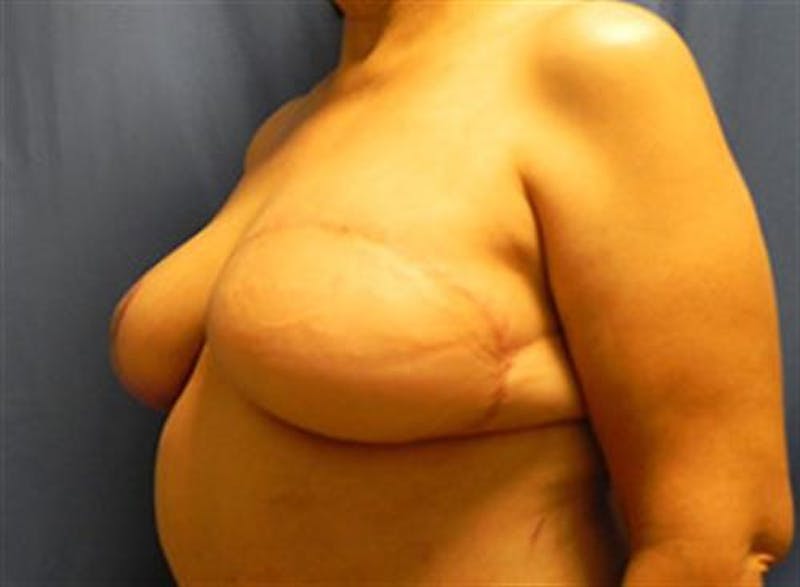 DIEP Flap Before & After Gallery - Patient 380696 - Image 4