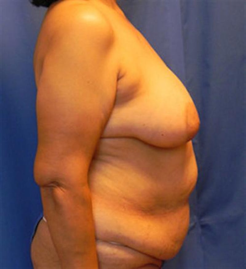DIEP Flap Before & After Gallery - Patient 380696 - Image 5