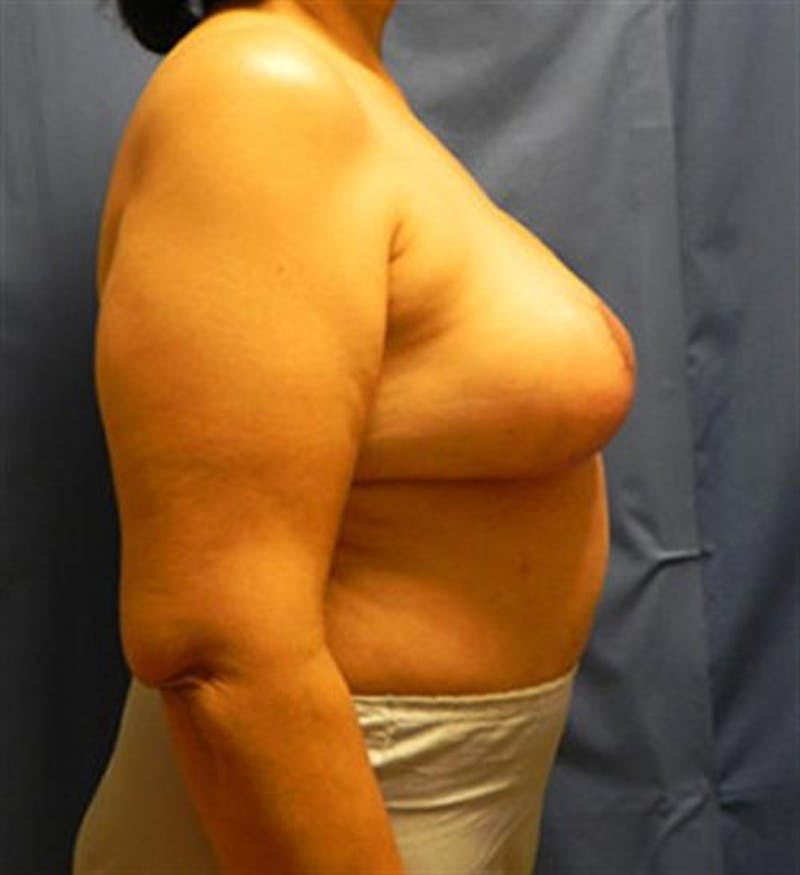 DIEP Flap Before & After Gallery - Patient 380696 - Image 6