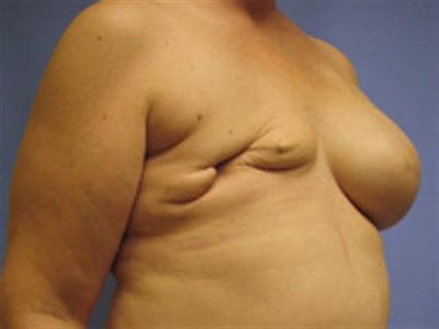 DIEP Flap Before & After Gallery - Patient 738884 - Image 1