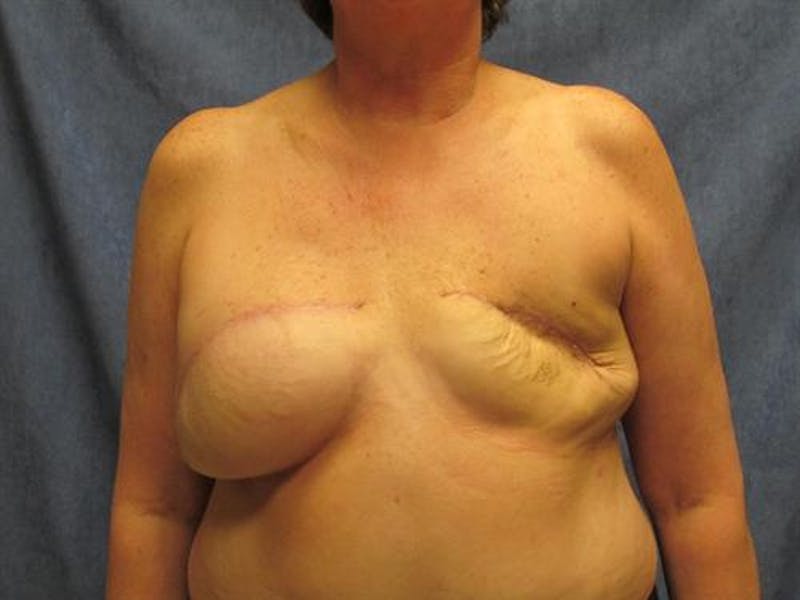 DIEP Flap Before & After Gallery - Patient 220368 - Image 1