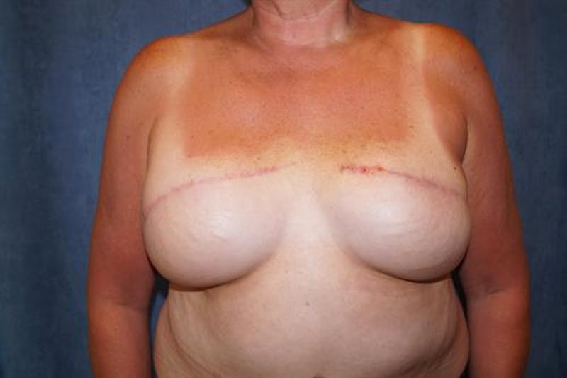 DIEP Flap Before & After Gallery - Patient 220368 - Image 2
