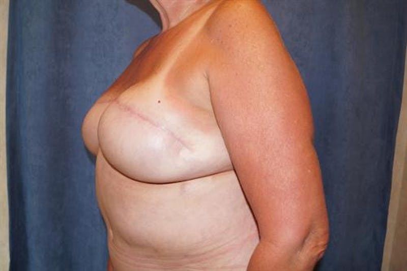 DIEP Flap Before & After Gallery - Patient 220368 - Image 4