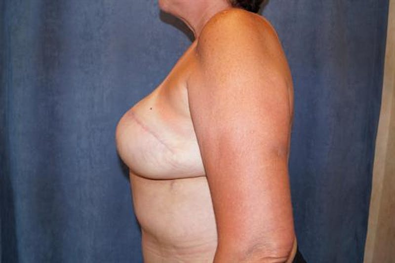 DIEP Flap Before & After Gallery - Patient 220368 - Image 6