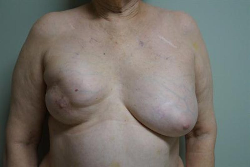 DIEP Flap Before & After Gallery - Patient 299435 - Image 1