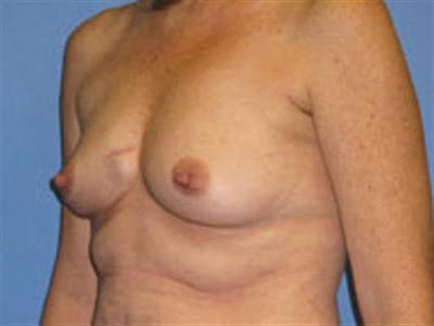 Implant Reconstruction Before & After Gallery - Patient 946316 - Image 1