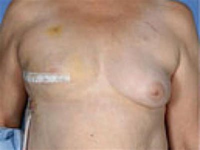 Implant Reconstruction Before & After Gallery - Patient 247587 - Image 1