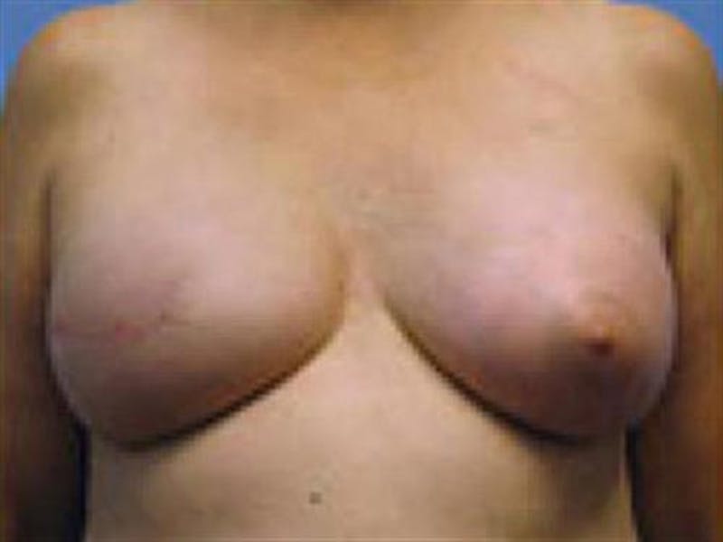 Implant Reconstruction Before & After Gallery - Patient 247587 - Image 3