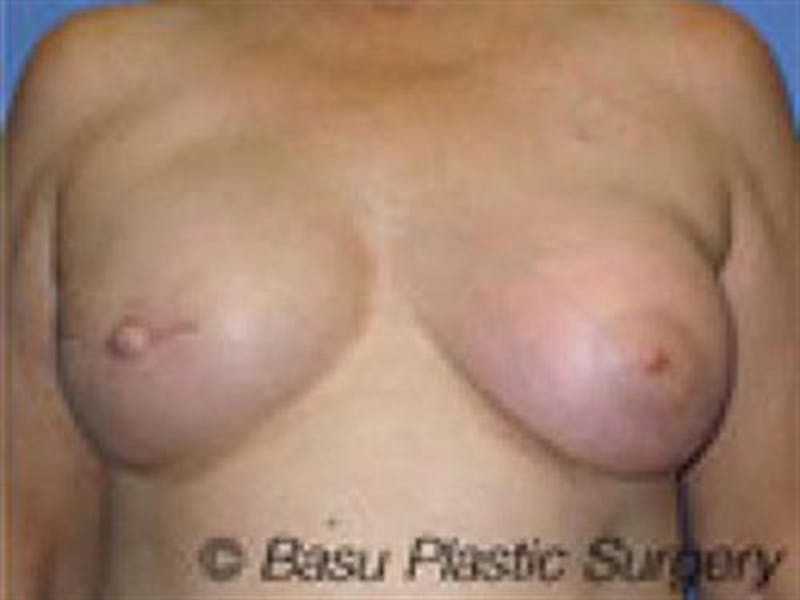 Implant Reconstruction Before & After Gallery - Patient 247587 - Image 4