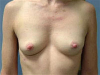 Implant Reconstruction Before & After Gallery - Patient 360176 - Image 1