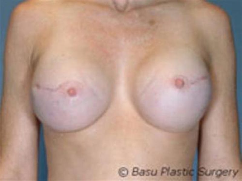Implant Reconstruction Before & After Gallery - Patient 360176 - Image 2