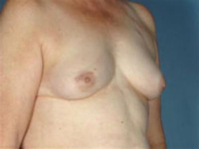 Implant Reconstruction Before & After Gallery - Patient 797666 - Image 1