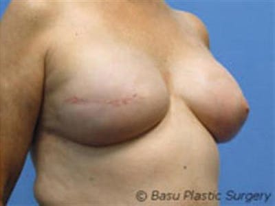 Implant Reconstruction Before & After Gallery - Patient 797666 - Image 2