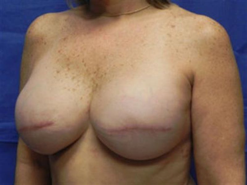 Implant Reconstruction Before & After Gallery - Patient 387563 - Image 4
