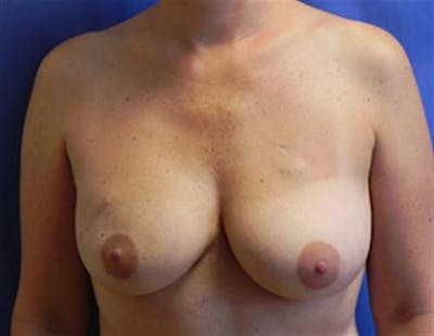 Implant Reconstruction Before & After Gallery - Patient 386576 - Image 1