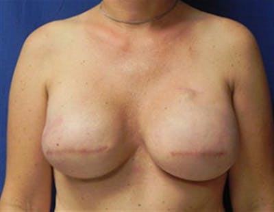 Implant Reconstruction Before & After Gallery - Patient 386576 - Image 2