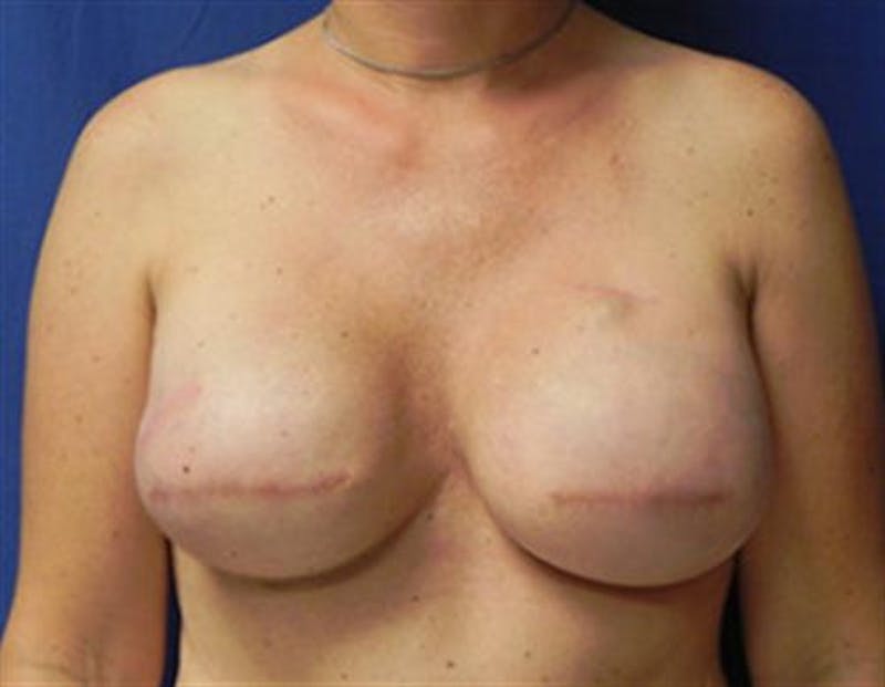Implant Reconstruction Before & After Gallery - Patient 386576 - Image 2