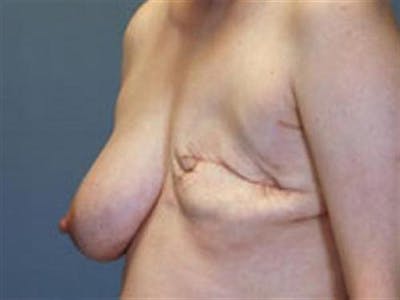 Latissimus Dorsi Flap Before & After Gallery - Patient 305258 - Image 1