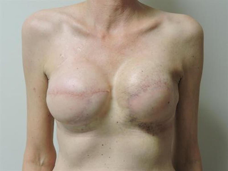 Latissimus Dorsi Flap Before & After Gallery - Patient 387567 - Image 2