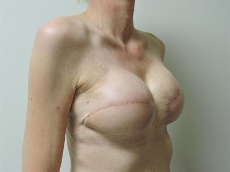 Latissimus Dorsi Flap Before & After Gallery - Patient 387567 - Image 4