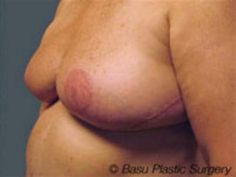 Lumpectomy Reconstruction Before & After Gallery - Patient 394424 - Image 2