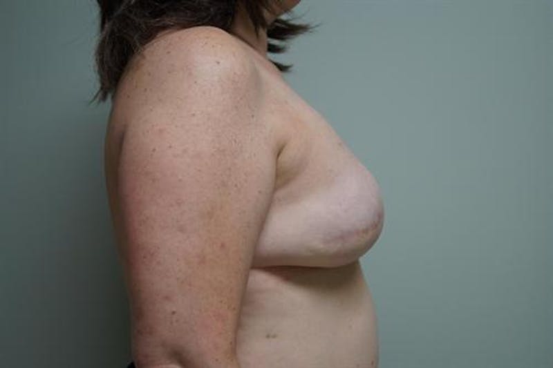 Tissue Expander Reconstruction Before & After Gallery - Patient 270011 - Image 6