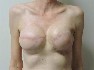 Tissue Expander Reconstruction Before & After Gallery - Patient 267849 - Image 2