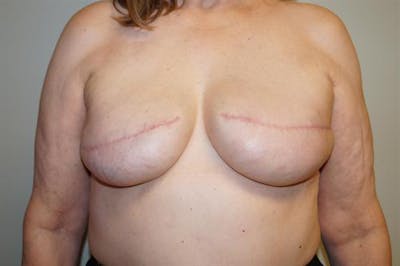 Tissue Expander Reconstruction Before & After Gallery - Patient 117841 - Image 2
