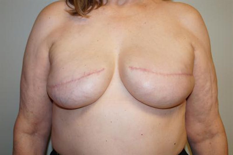 Tissue Expander Reconstruction Before & After Gallery - Patient 117841 - Image 2