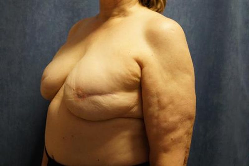 Tissue Expander Reconstruction Before & After Gallery - Patient 117841 - Image 3