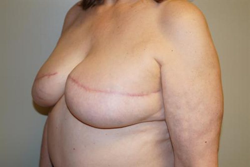 Tissue Expander Reconstruction Before & After Gallery - Patient 117841 - Image 4