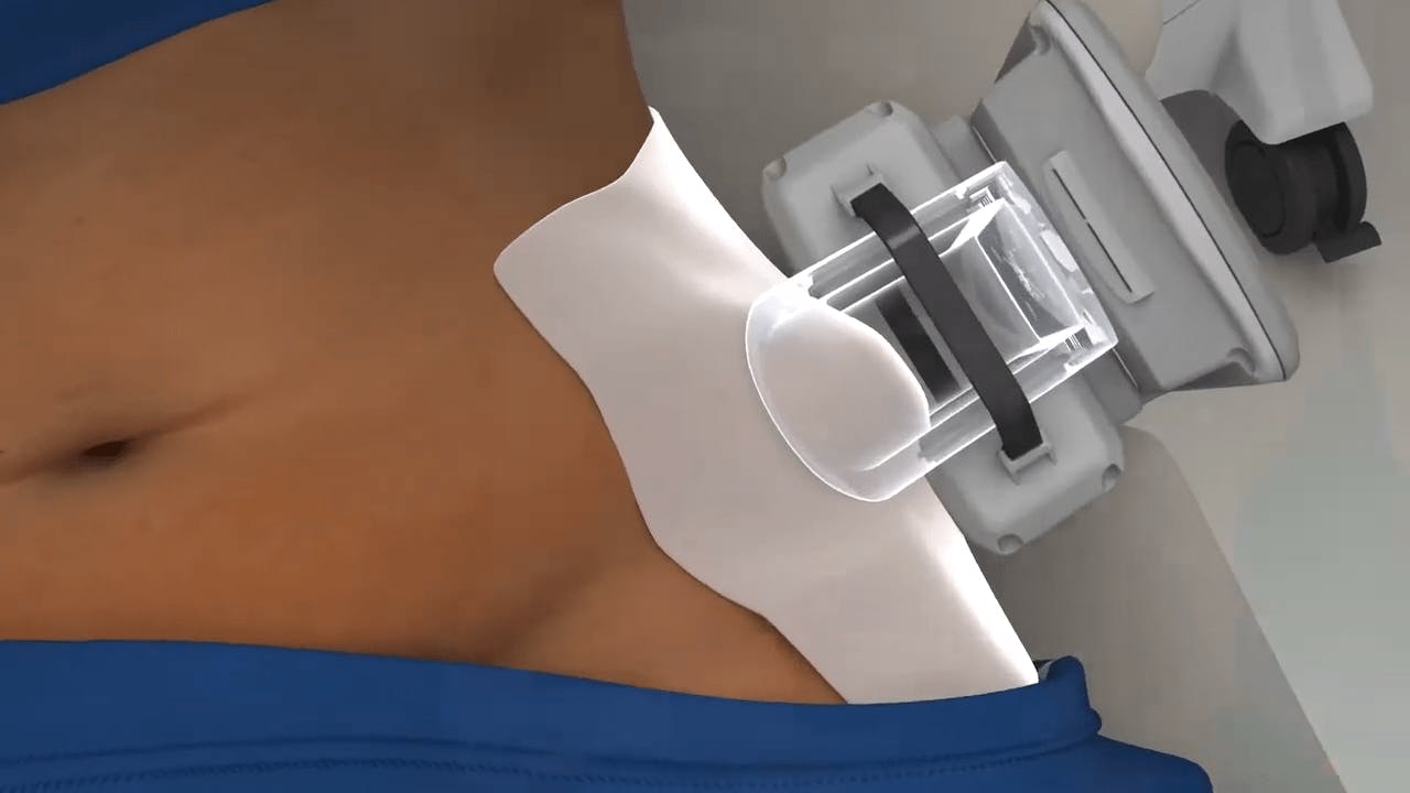 coolsculpting treatment video