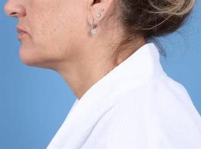 CoolSculpting Before & After Gallery - Patient 255505 - Image 2