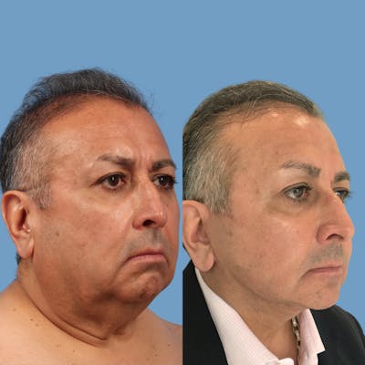 Facelift Before & After Gallery - Patient 222130 - Image 1