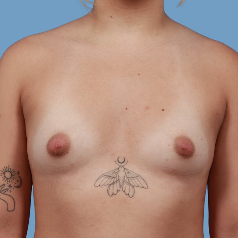 Breast Augmentation Before & After Gallery - Patient 302746 - Image 1