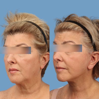 Facelift Before & After Gallery - Patient 121544 - Image 1