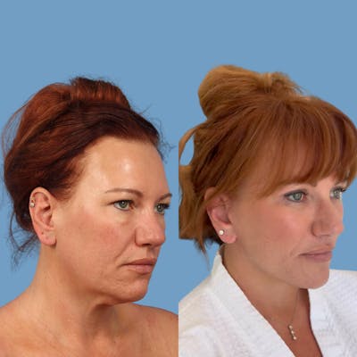 Facelift Before & After Gallery - Patient 219163 - Image 1