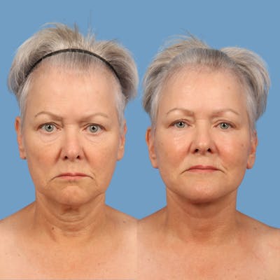 Facelift Before & After Gallery - Patient 220716 - Image 1