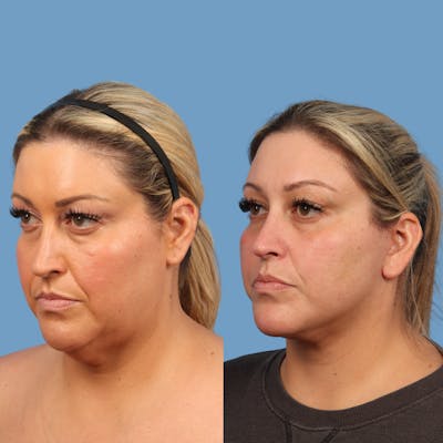 Facelift Before & After Gallery - Patient 193166 - Image 1