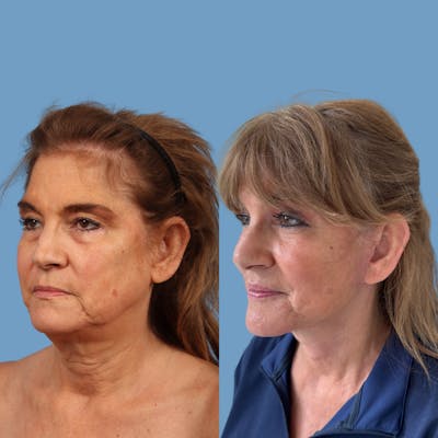 Facelift Before & After Gallery - Patient 425849 - Image 1