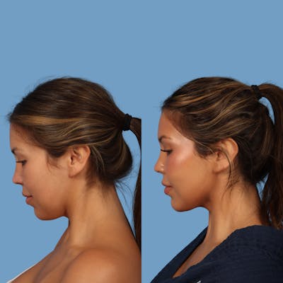 FaceTite / NeckTite Before & After Gallery - Patient 903250 - Image 1