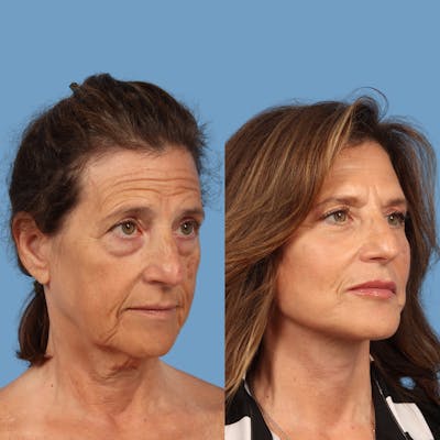Facelift Before & After Gallery - Patient 101039 - Image 1
