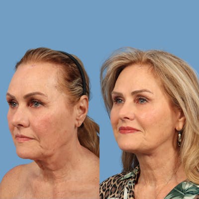 Facelift Before & After Gallery - Patient 196605 - Image 1