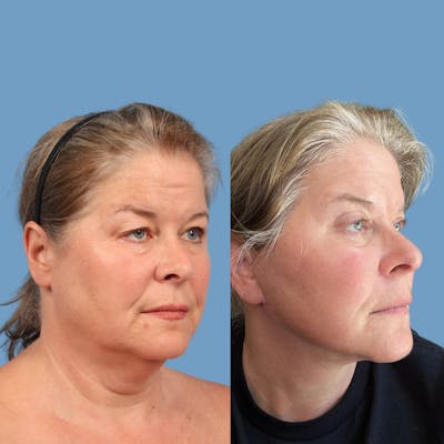 Facelift Before & After Gallery - Patient 365520 - Image 1
