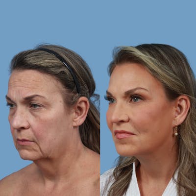 Facelift Before & After Gallery - Patient 370488 - Image 1