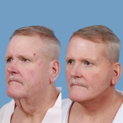 Facelift Before & After Gallery - Patient 316000 - Image 1