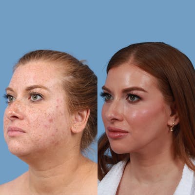 Facelift Before & After Gallery - Patient 179644 - Image 1
