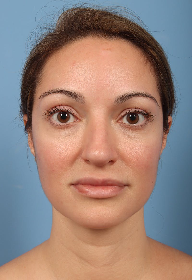 Rhinoplasty Before & After Gallery - Patient 197849 - Image 5