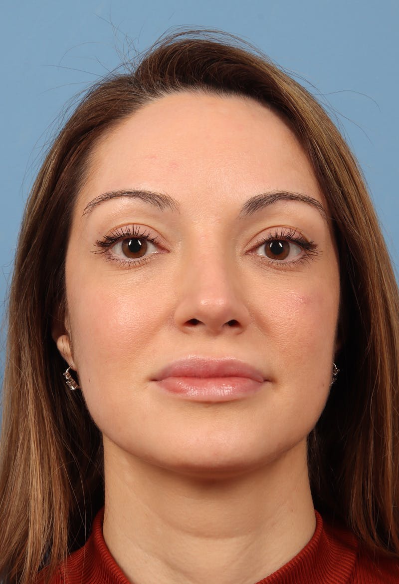 Rhinoplasty Before & After Gallery - Patient 197849 - Image 6