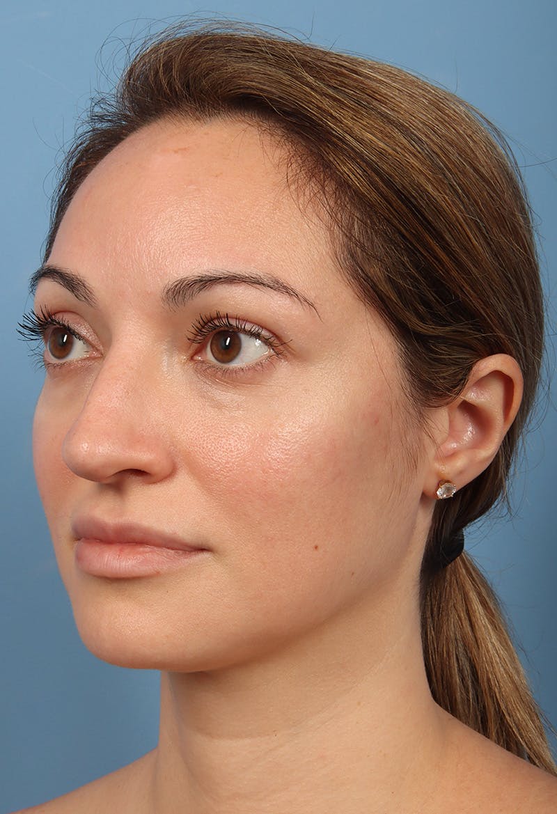 Rhinoplasty Before & After Gallery - Patient 197849 - Image 3